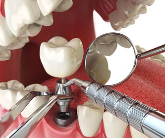 Prótesis dentales: Tratamientos de Clínica Dental Liliana Rinaldi