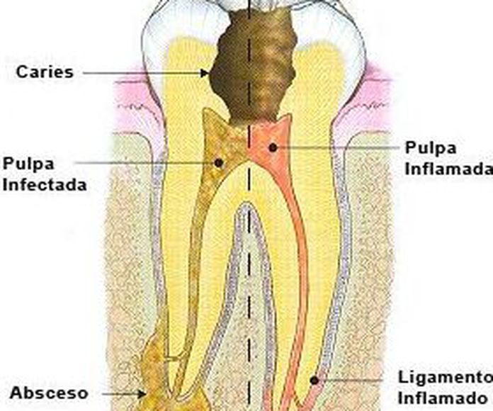 Endodoncia: Tratamientos de Clínica dental Vall Hebrón