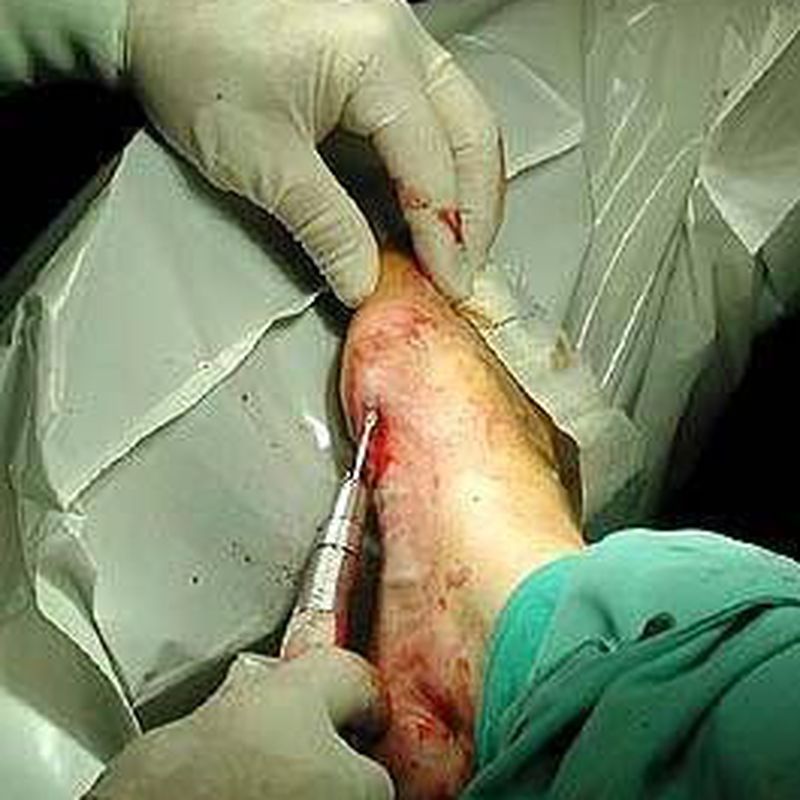 Cirugía del pie : Tratamientos de Clínica Podológica Serrano Argüello
