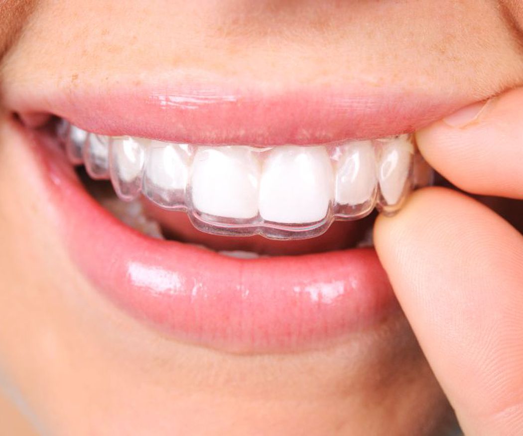 Consejos para el mantenimiento de tu ortodoncia invisible