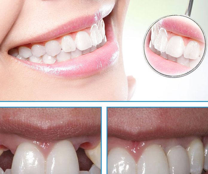 Rehabilitacion oral: Tratamientos de Clínica dental Vall Hebrón
