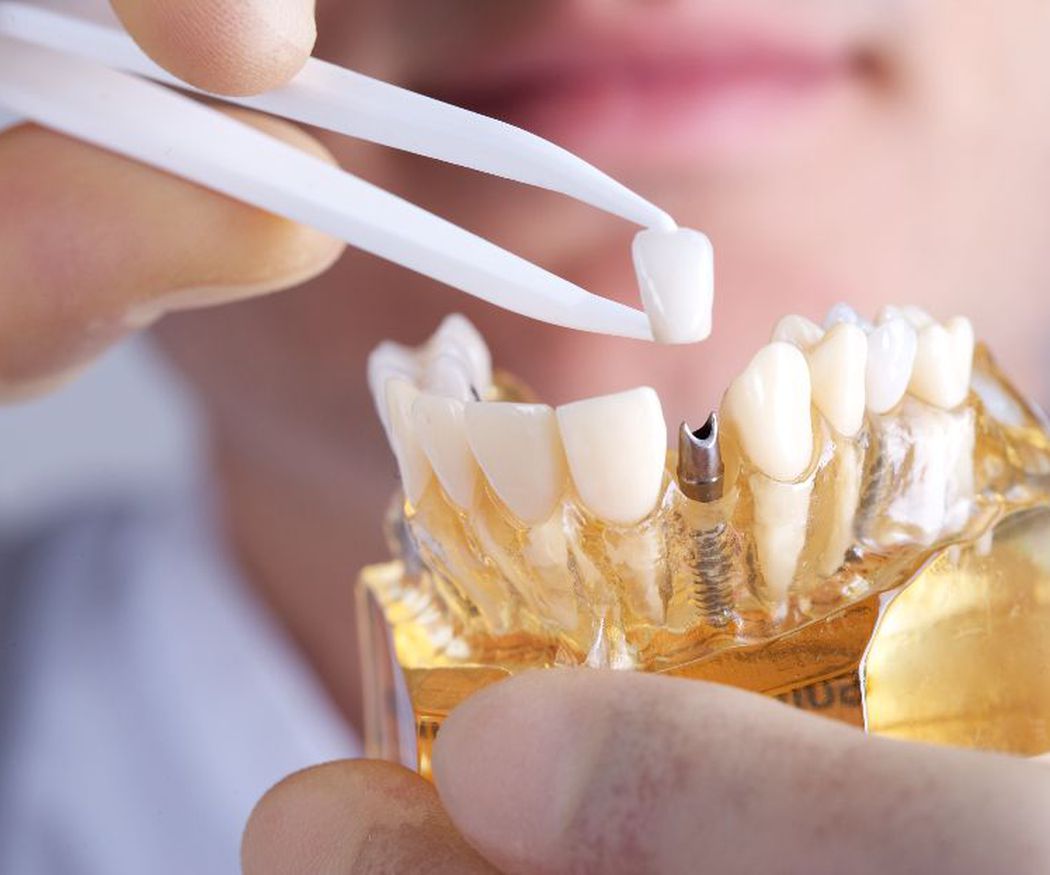 Opciones de implantes dentales, salud y belleza juntas