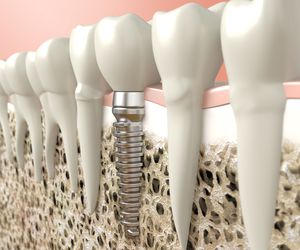 Implantes dentales en El Prat de Llobregat