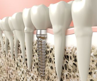 Estética dental: Tratamientos de Suavilaser