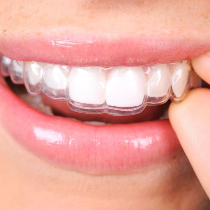 Ortodoncia invisible. Alineadores dentales: Tratamientos de Clínica Dental Liliana Rinaldi