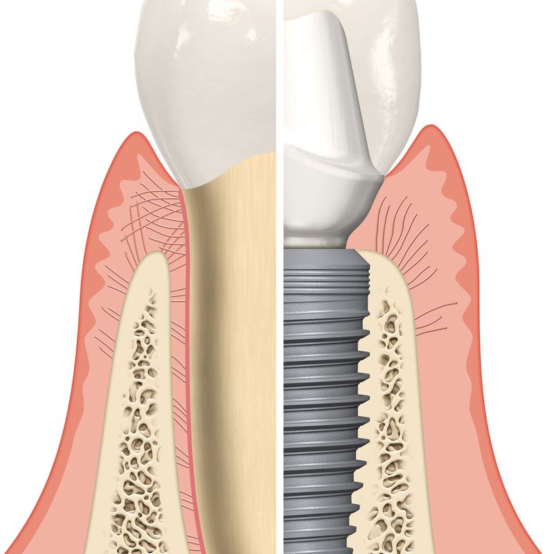 implante dental bilbao