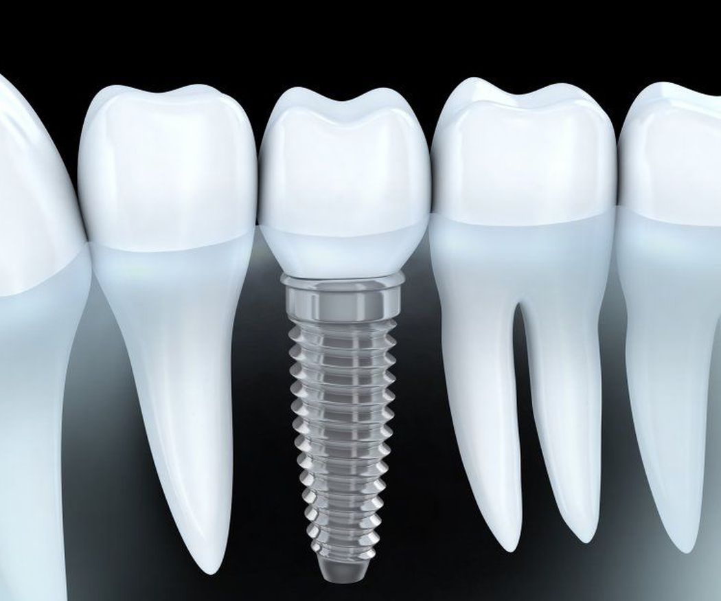 ¿Por qué es necesario utilizar implantes dentales?