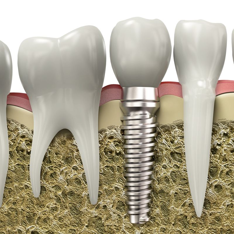 Implantología: Tratamientos de Clínica Dental Liliana Rinaldi