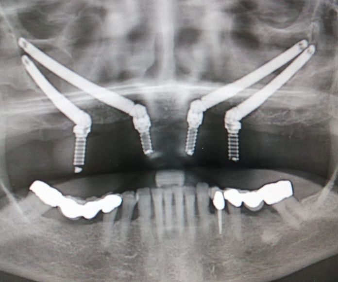 Implantes cigomáticos: Tratamientos de Clínica dental Vall Hebrón }}
