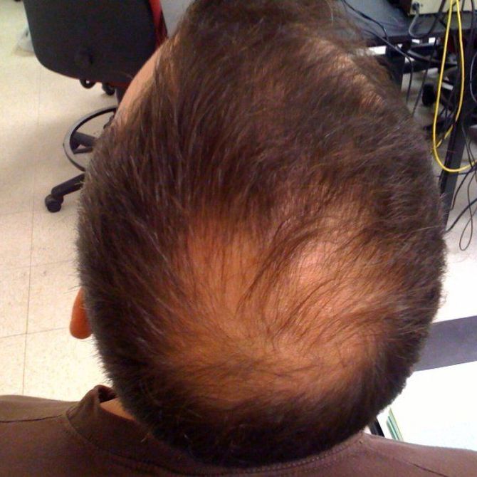 Falsas creencias sobre la alopecia